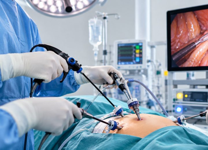Laparoscopic Surgery